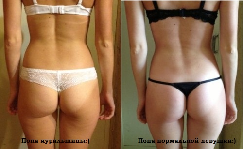 Целлюлит до и после